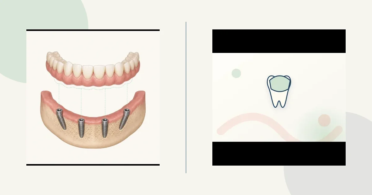 رسم مقارنة تعليمي: Fixed arch vs implant-retained removable