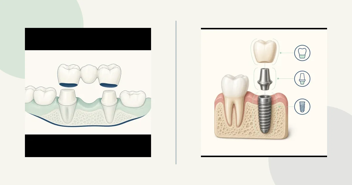 Replace one missing tooth: cut adjacent teeth or place implant comparison graphic