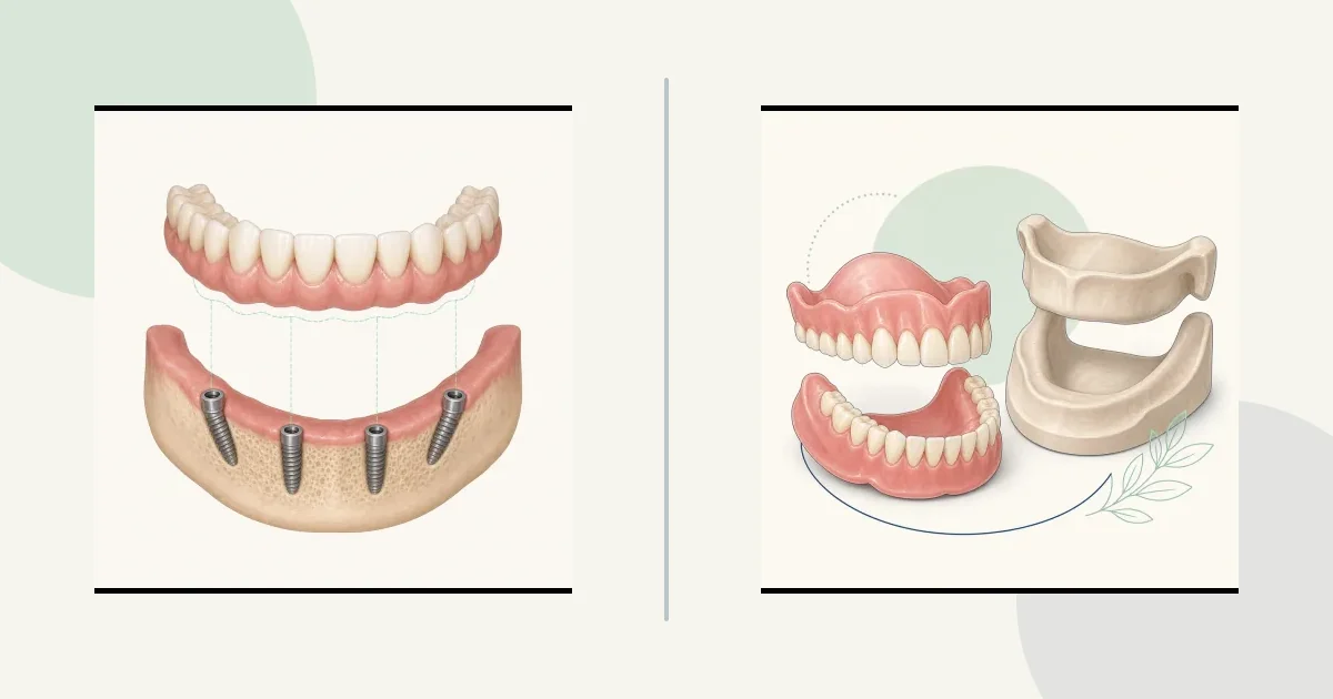 رسم مقارنة تعليمي: Full-arch fixed vs removable