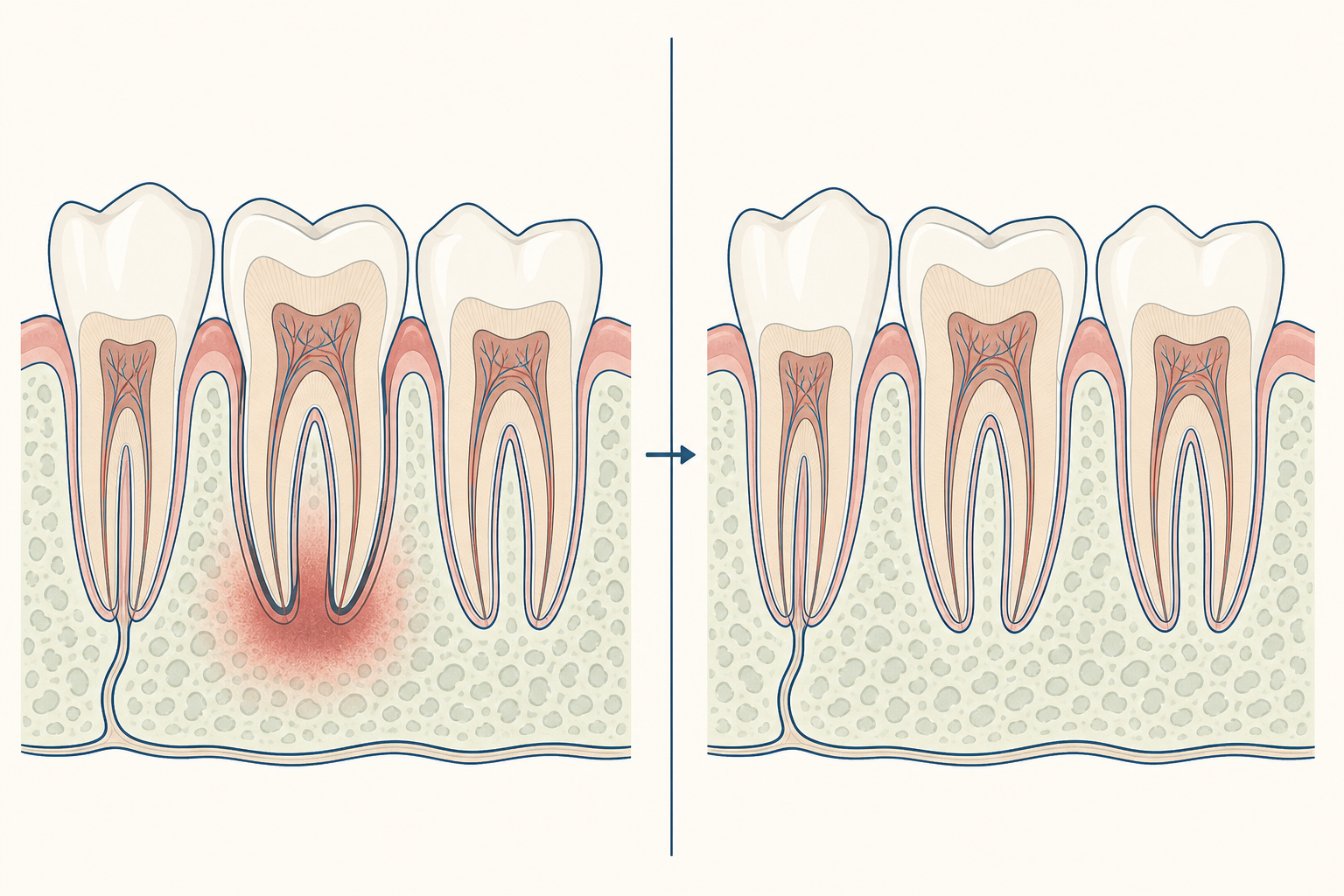Illustrative diagram: Acute Apical Periodontitis
