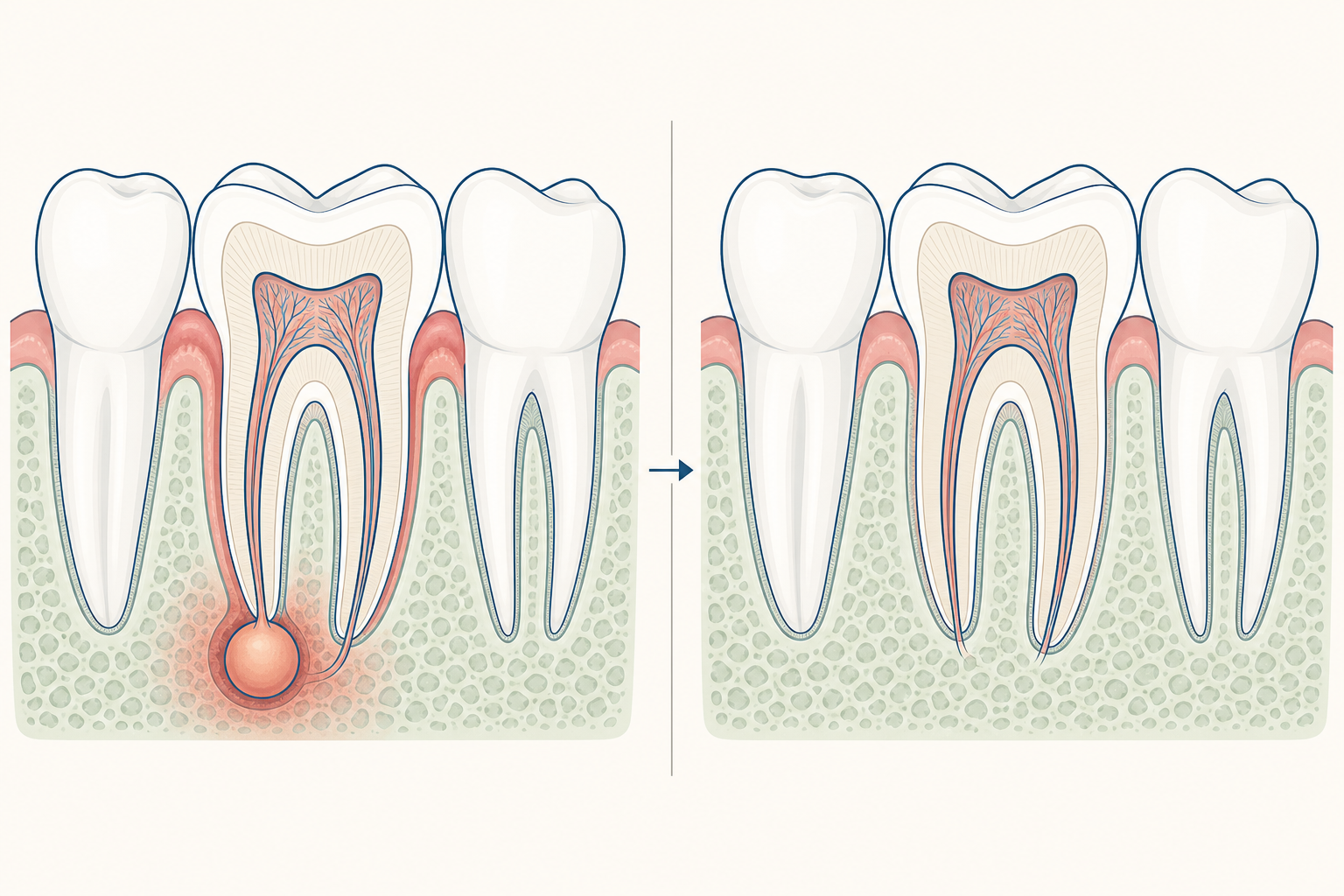 Illustrative diagram: Tooth Abscess