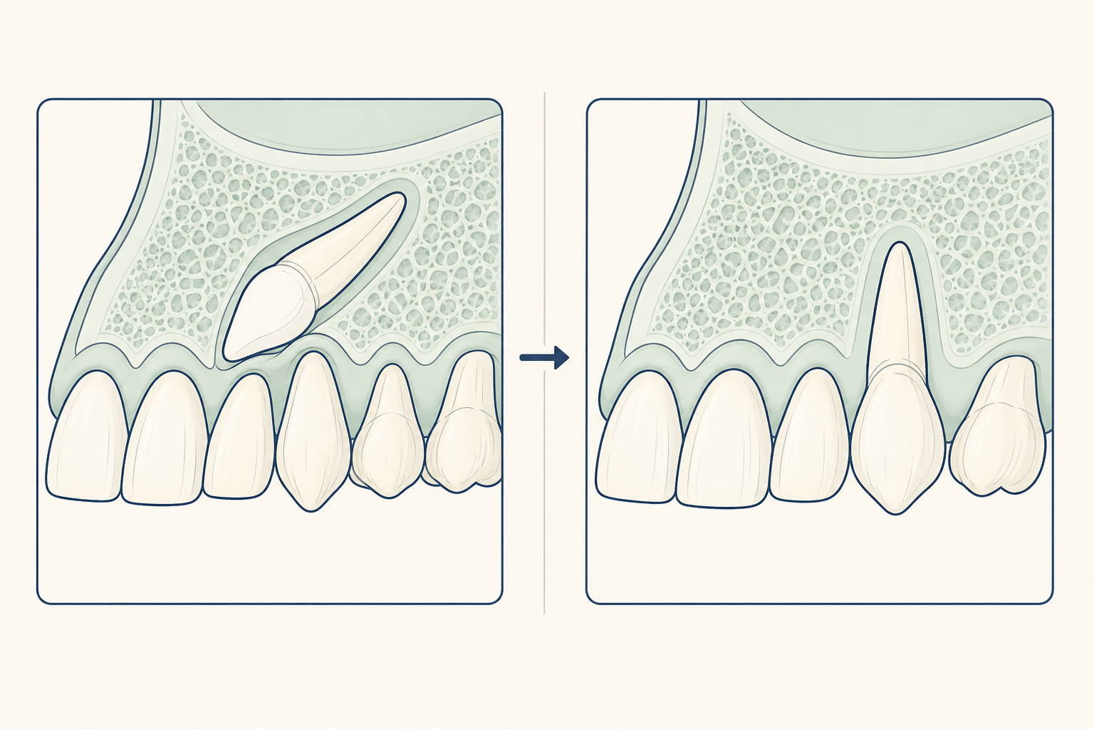 Illustrative diagram: Impacted Canine