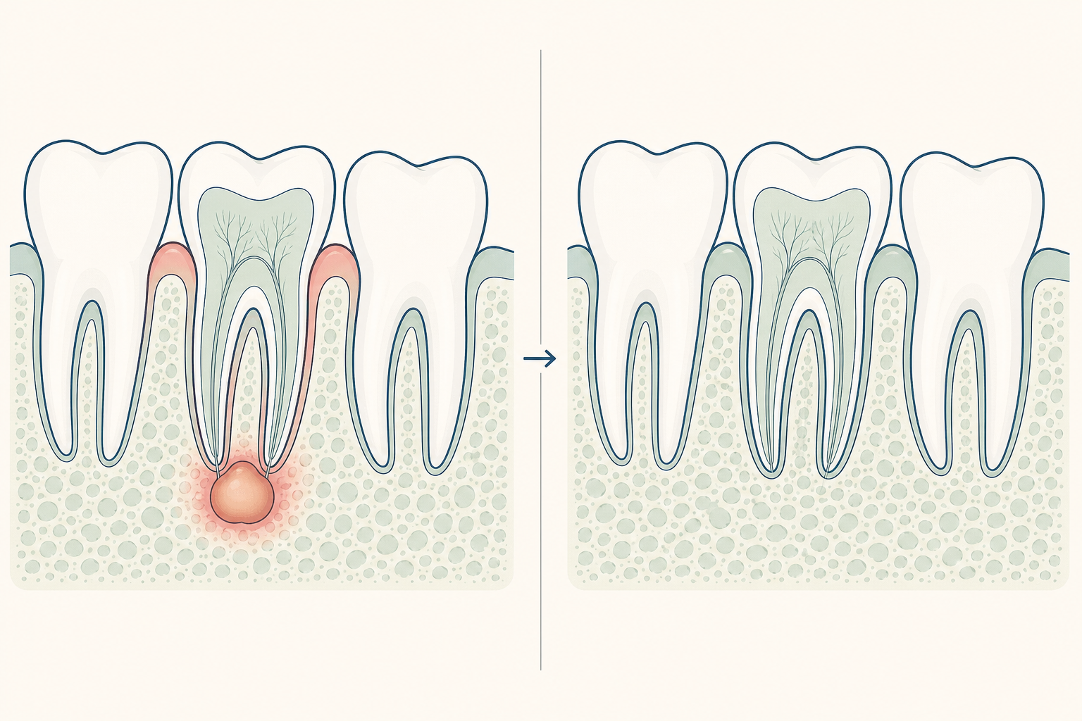 Illustrative diagram: Periapical Abscess Without Sinus