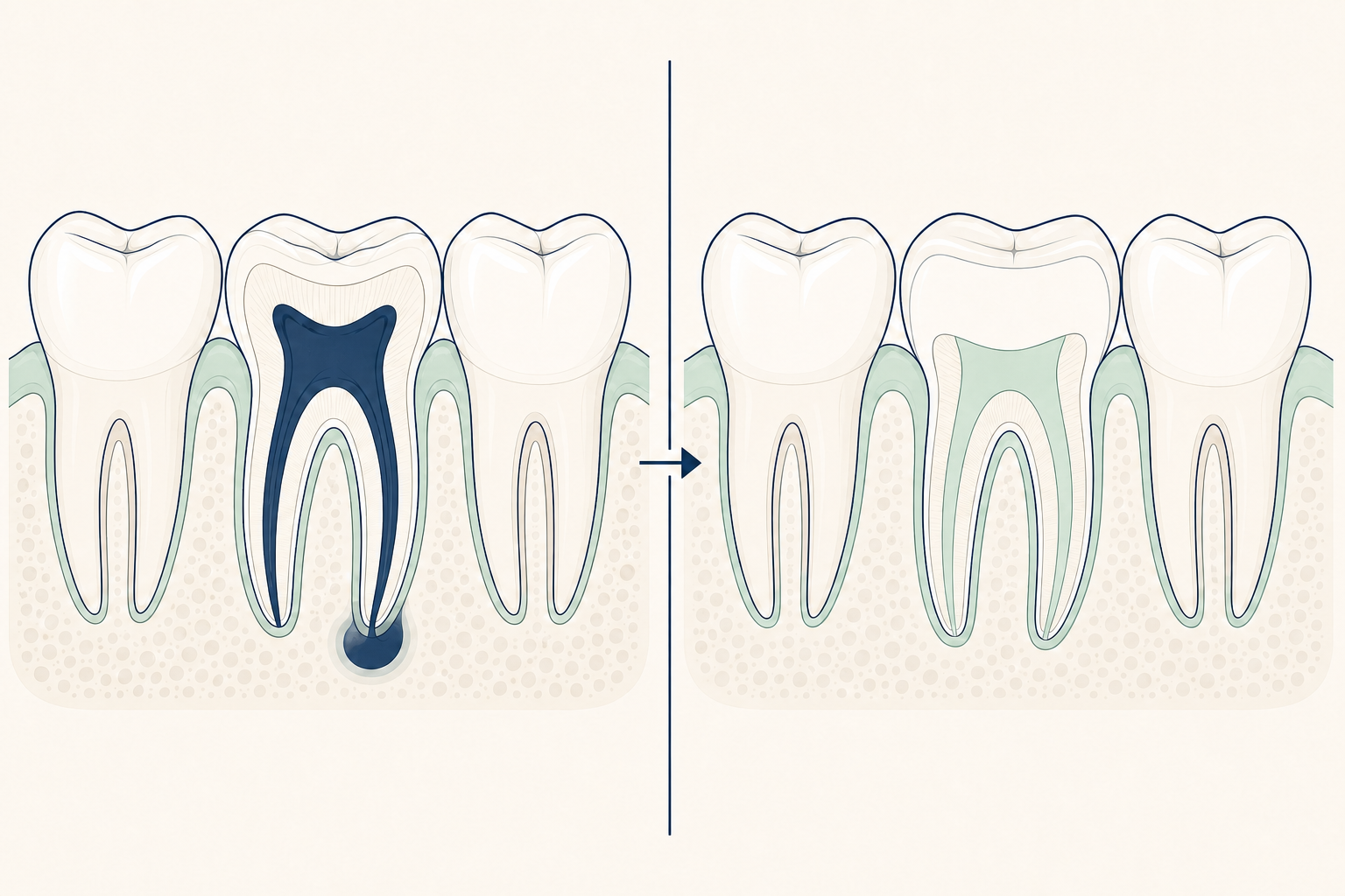 Illustrative diagram: Pulp Necrosis