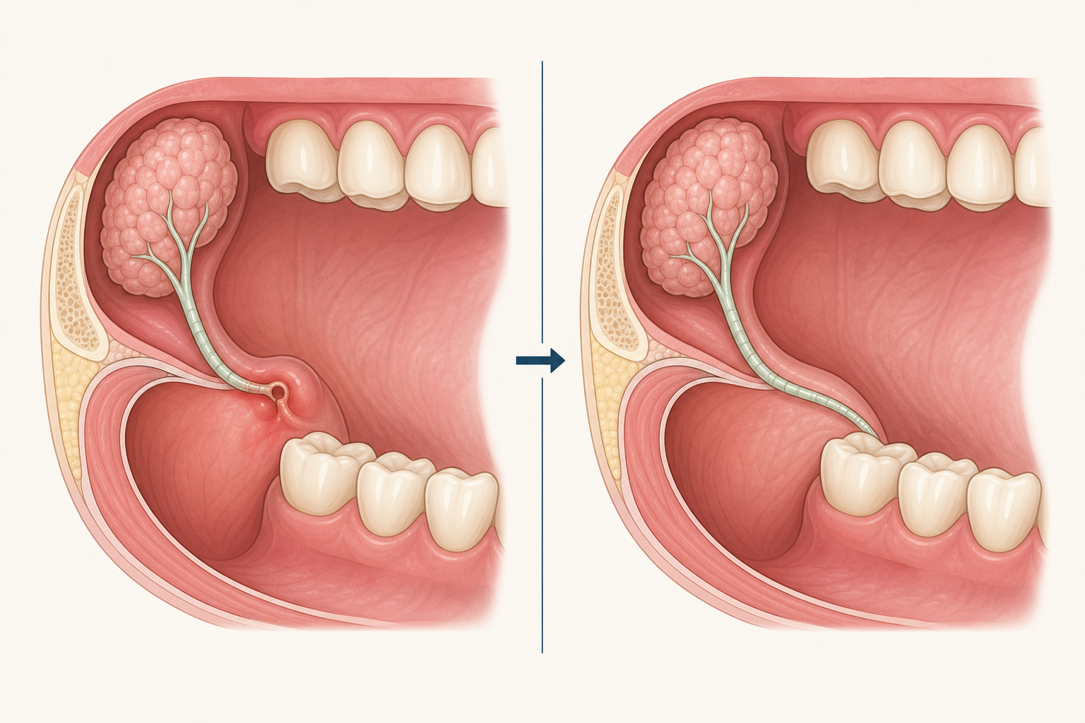 Illustrative diagram: Salivary Gland Fistula