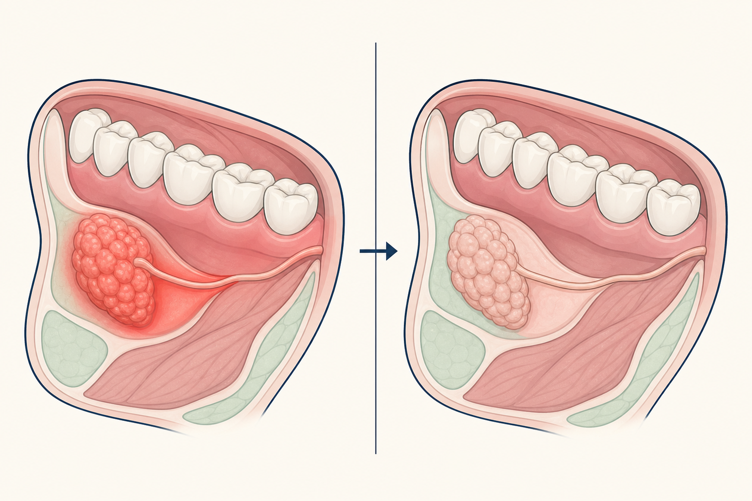 Illustrative diagram: Salivary Gland Infection