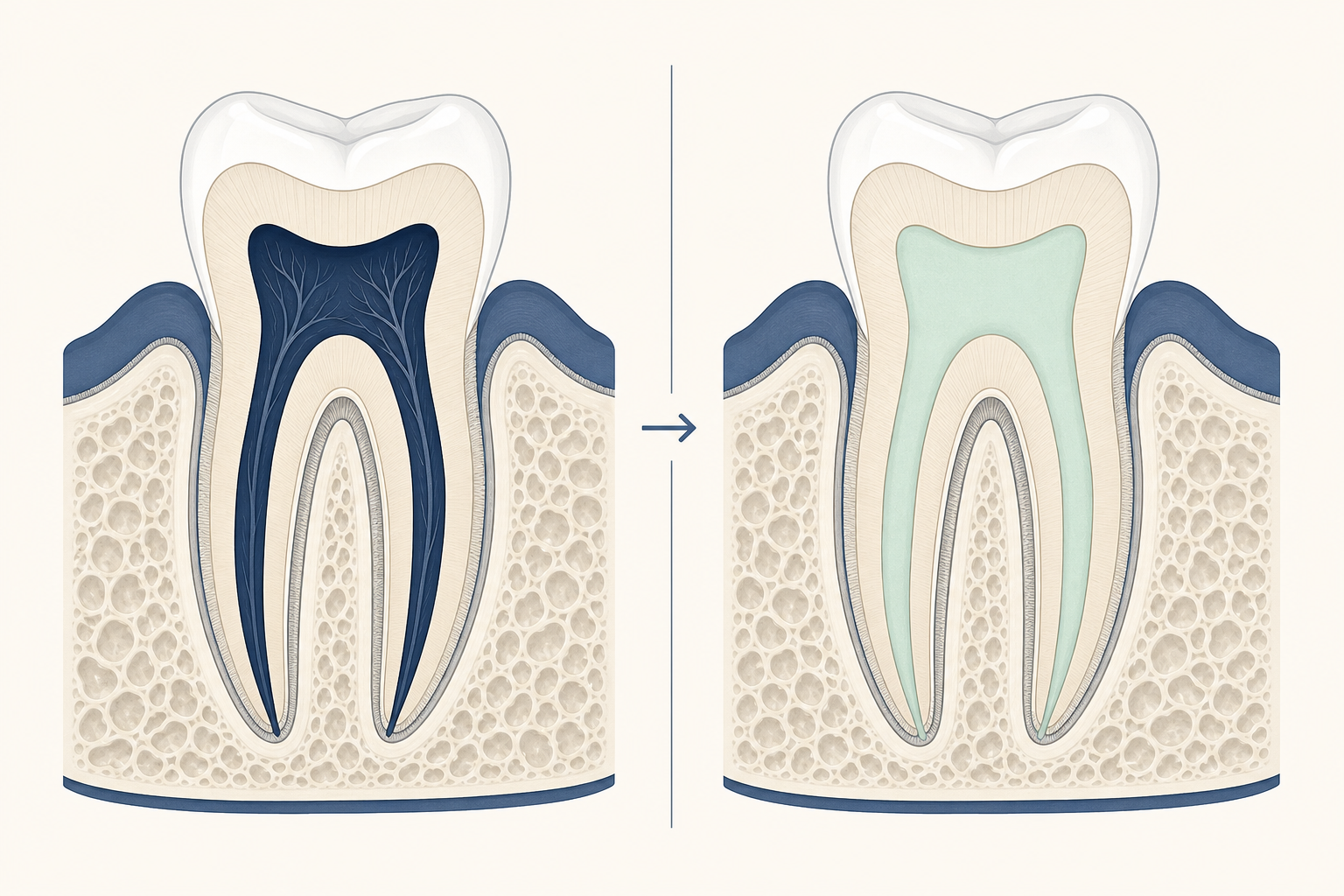 Illustrative diagram: Root Canal