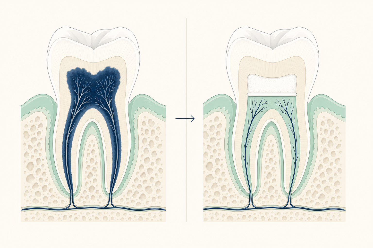 Illustrative diagram: Vital Pulp Therapy