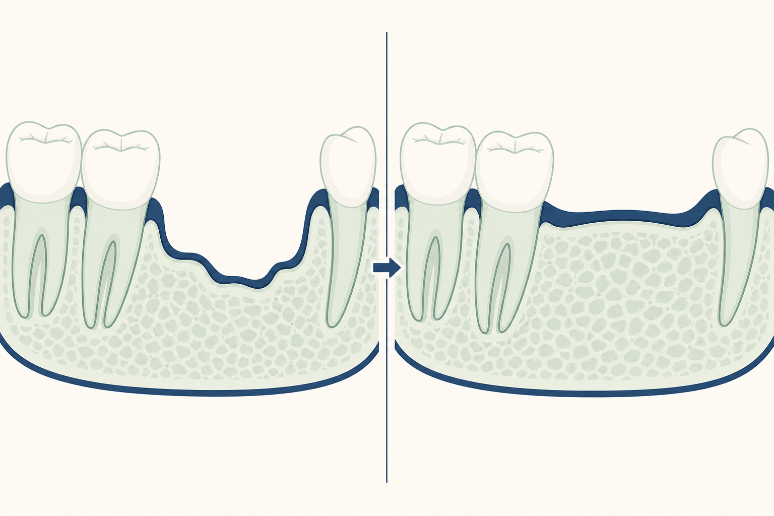 Illustrative diagram: Alveoloplasty