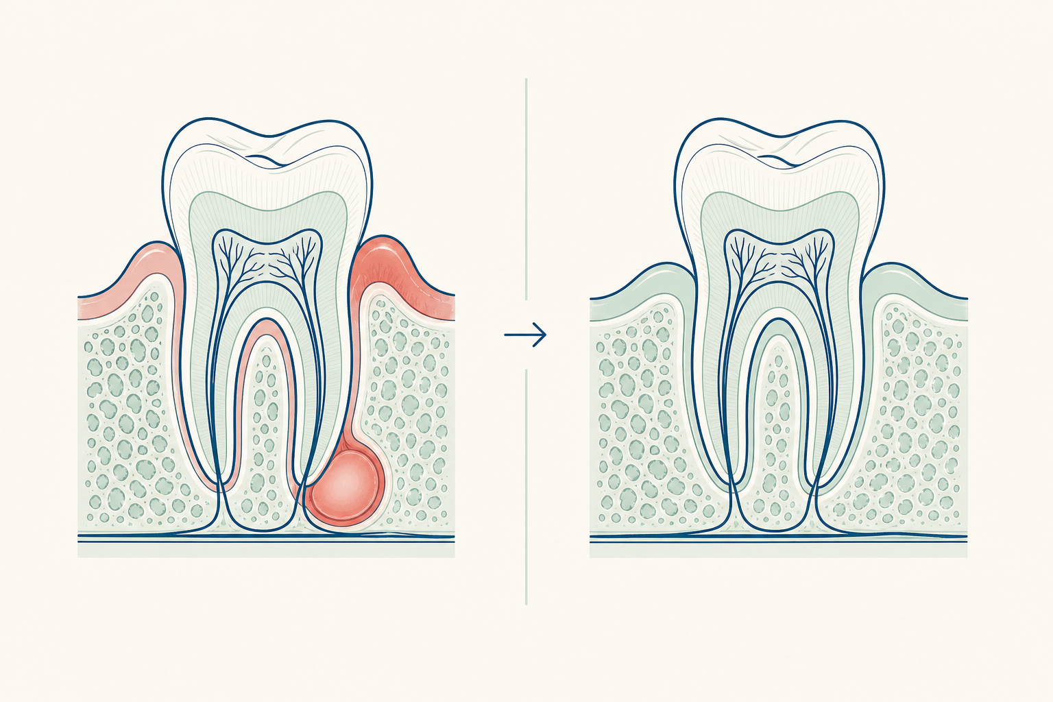 Illustrative diagram: Dental Abscess Drainage