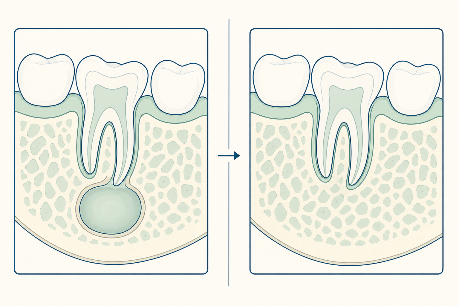 Illustrative diagram: Dental Cyst Removal