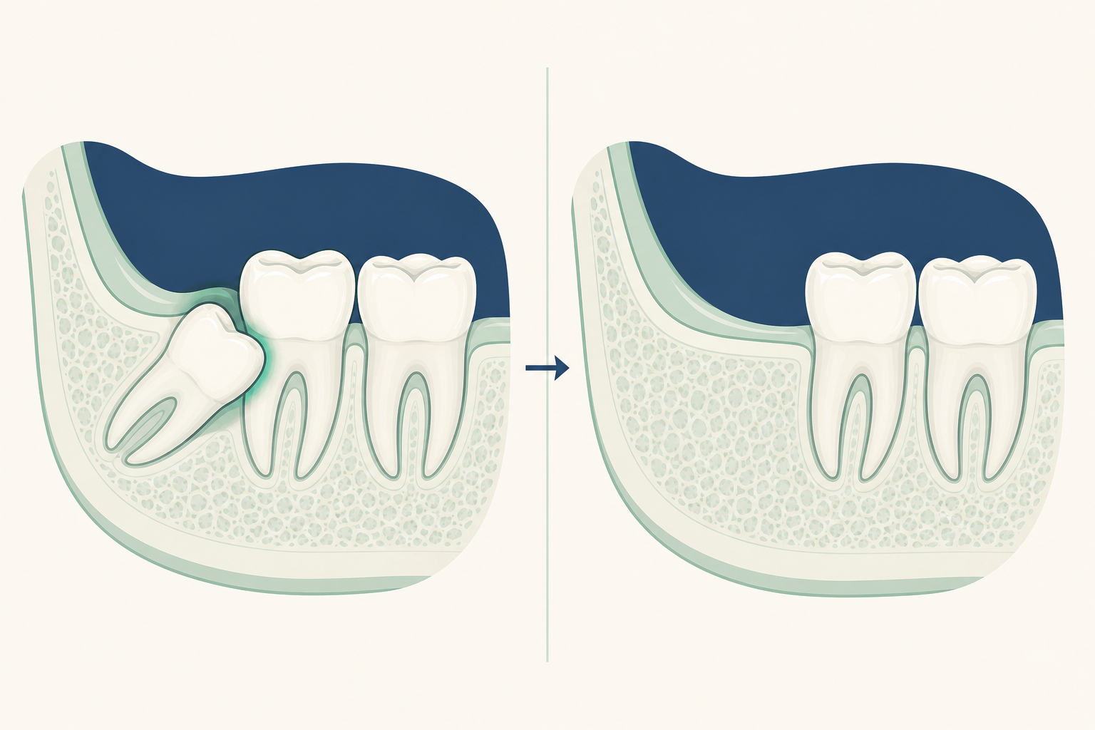 Illustrative diagram: Wisdom Tooth Extraction
