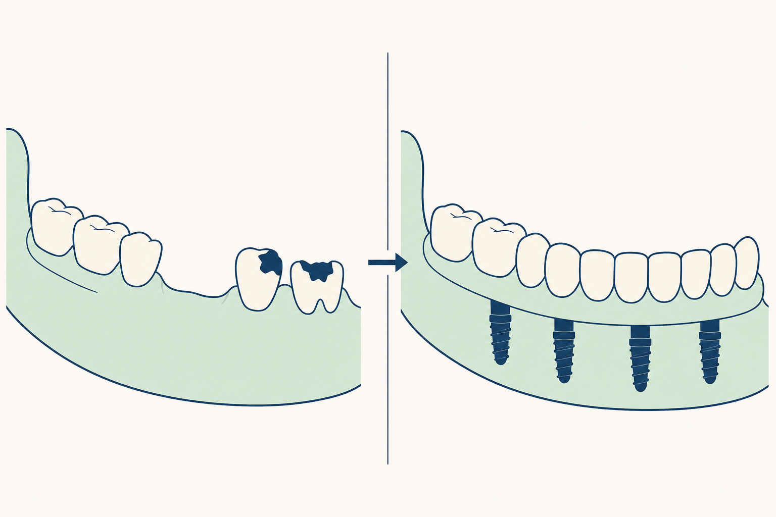 Illustrative diagram: Implant-Supported Dentures