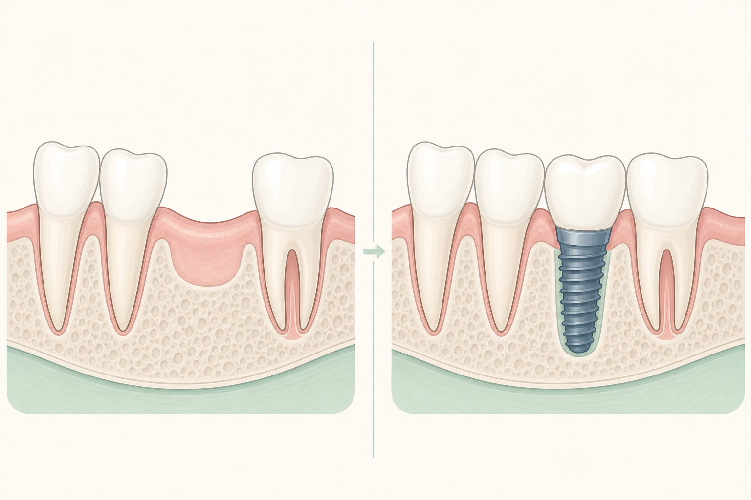 Illustrative diagram: Delayed Implant Placement