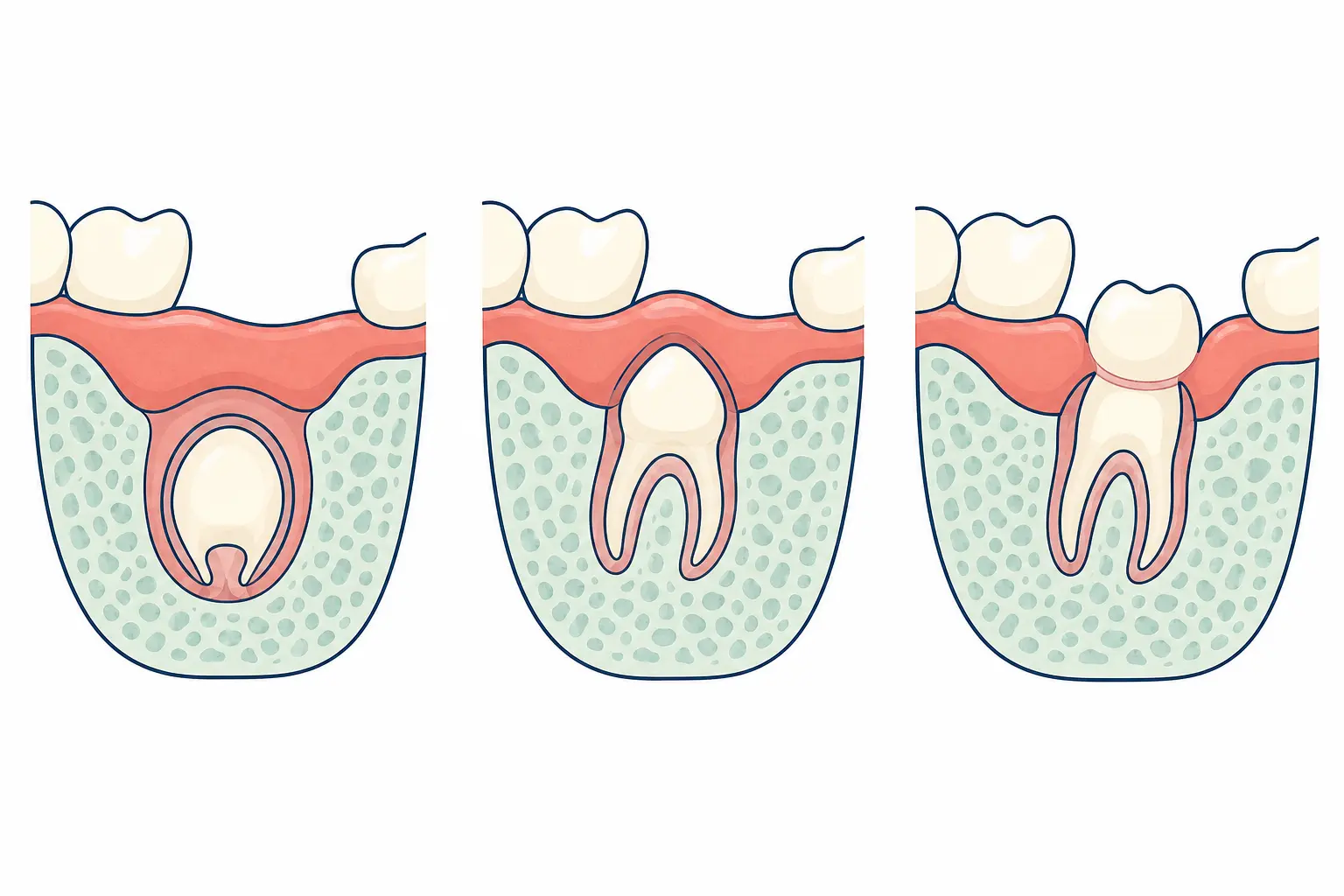 Teething Syndrome dental educational illustration