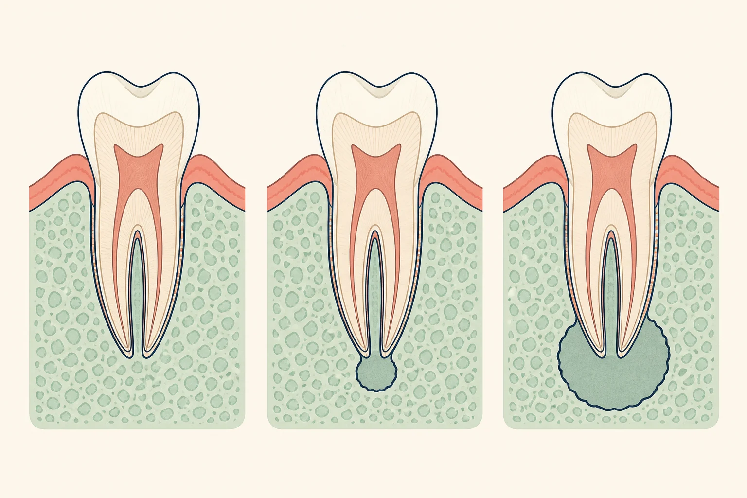 Chronic Apical Periodontitis dental educational illustration