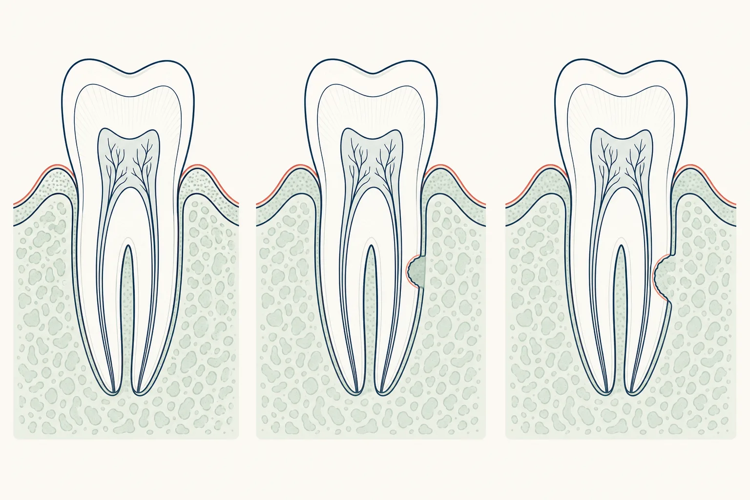 Odontoclasia dental educational illustration