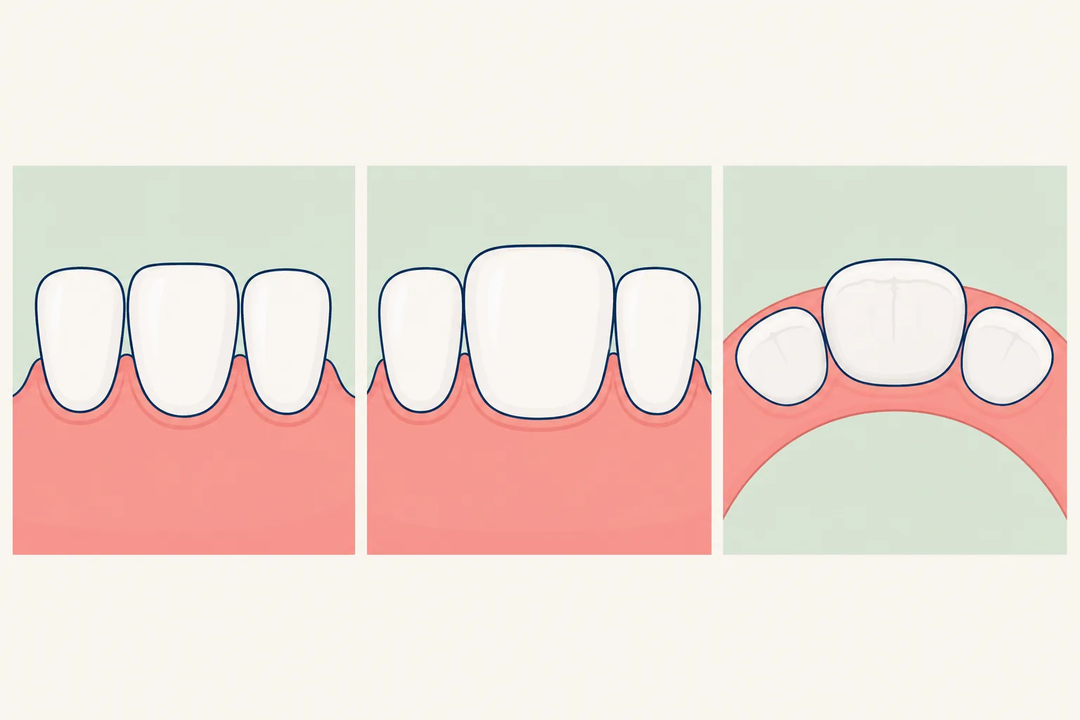 Macrodontia dental educational illustration