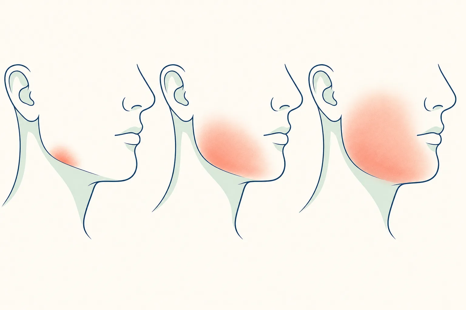 Oral Cellulitis dental educational illustration