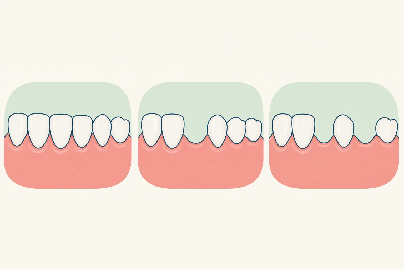 Missing Teeth dental educational illustration