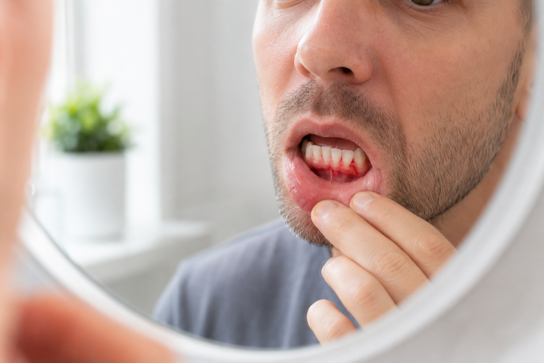 Gum Disease