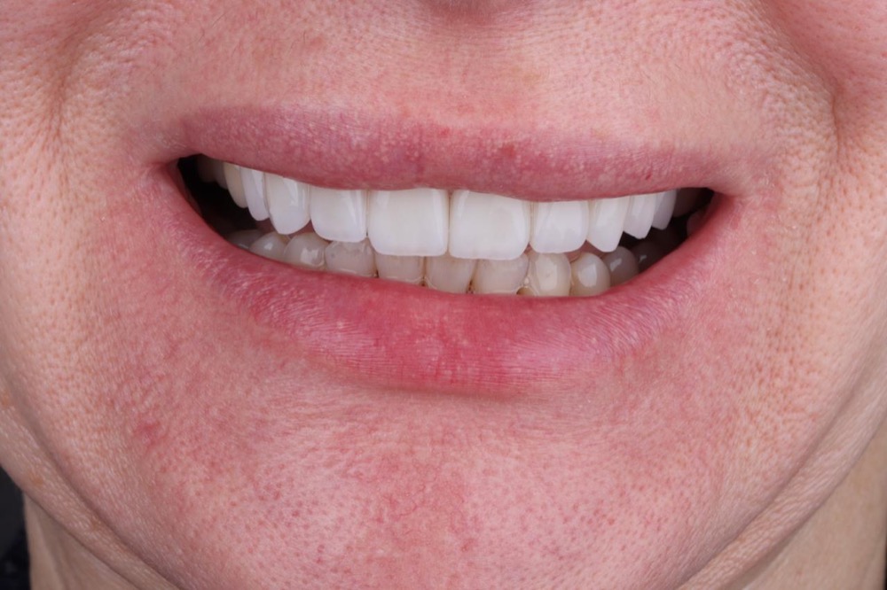 Porcelain veneers after