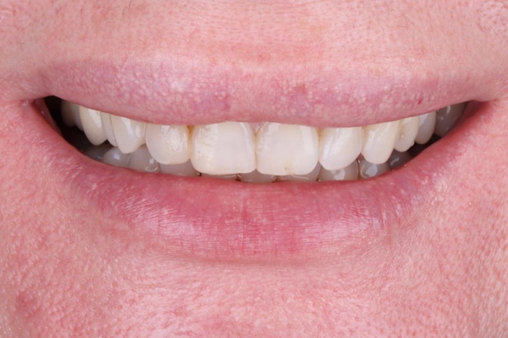 Porcelain veneers before
