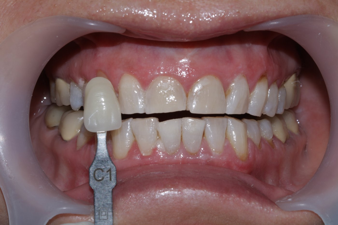 Teeth whitening after
