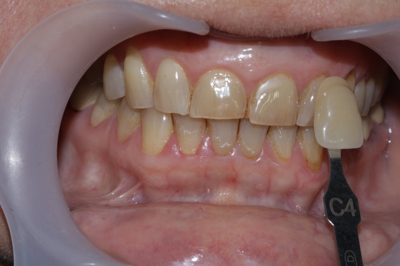 Teeth whitening before