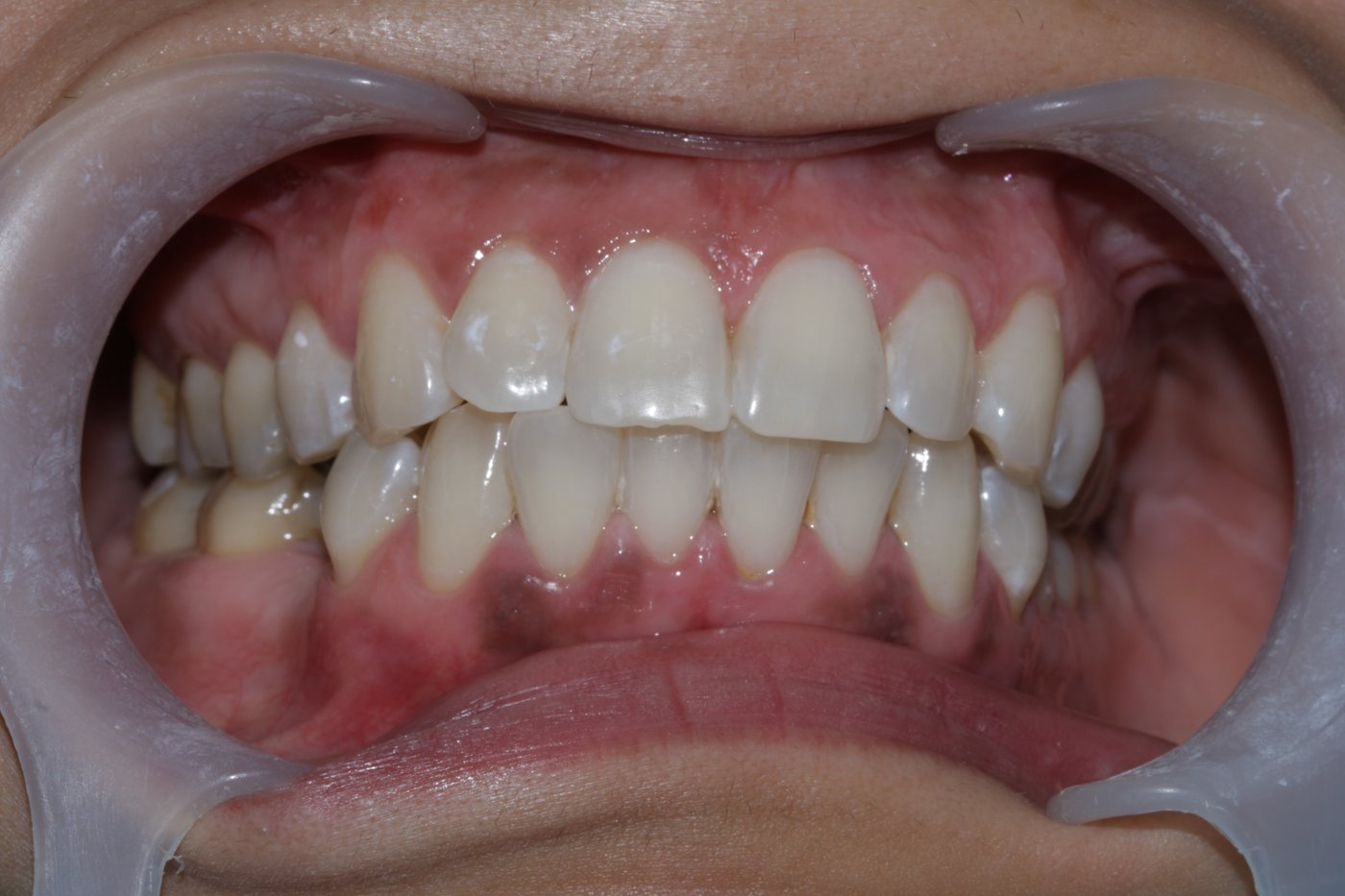 Teeth whitening after