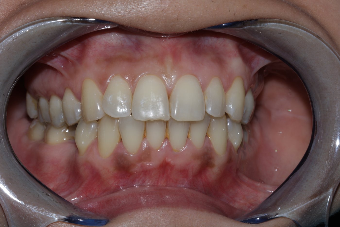 Teeth whitening before