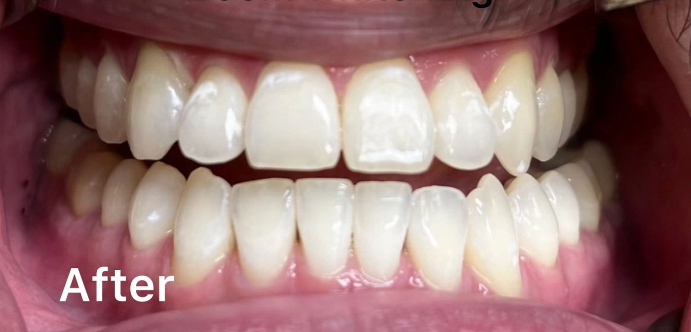 Zoom teeth whitening after
