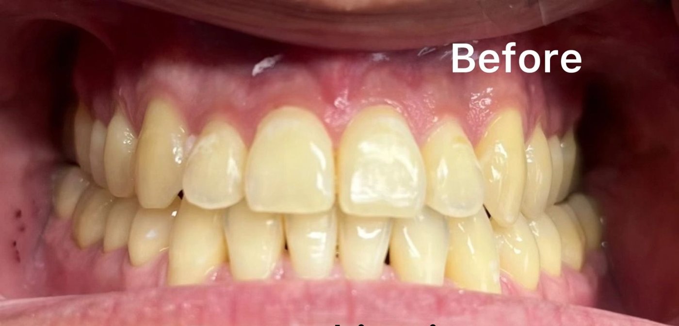 Zoom teeth whitening before