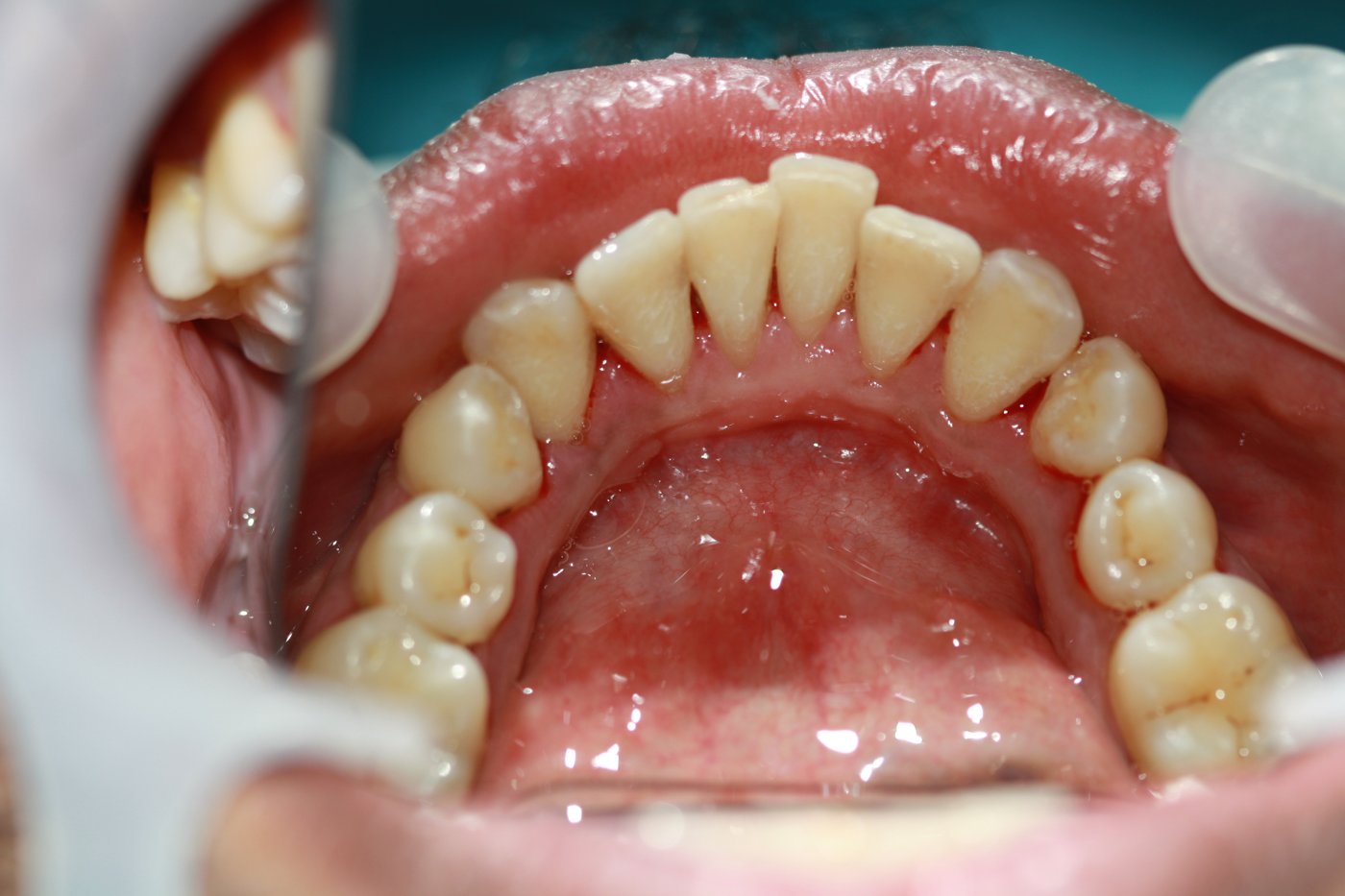 Calculus & stain removal after