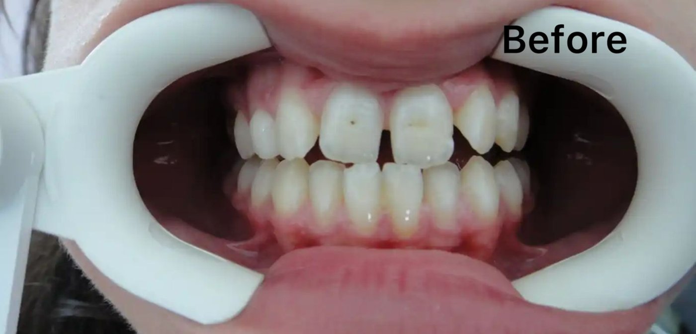 Composite bonding & restoration before