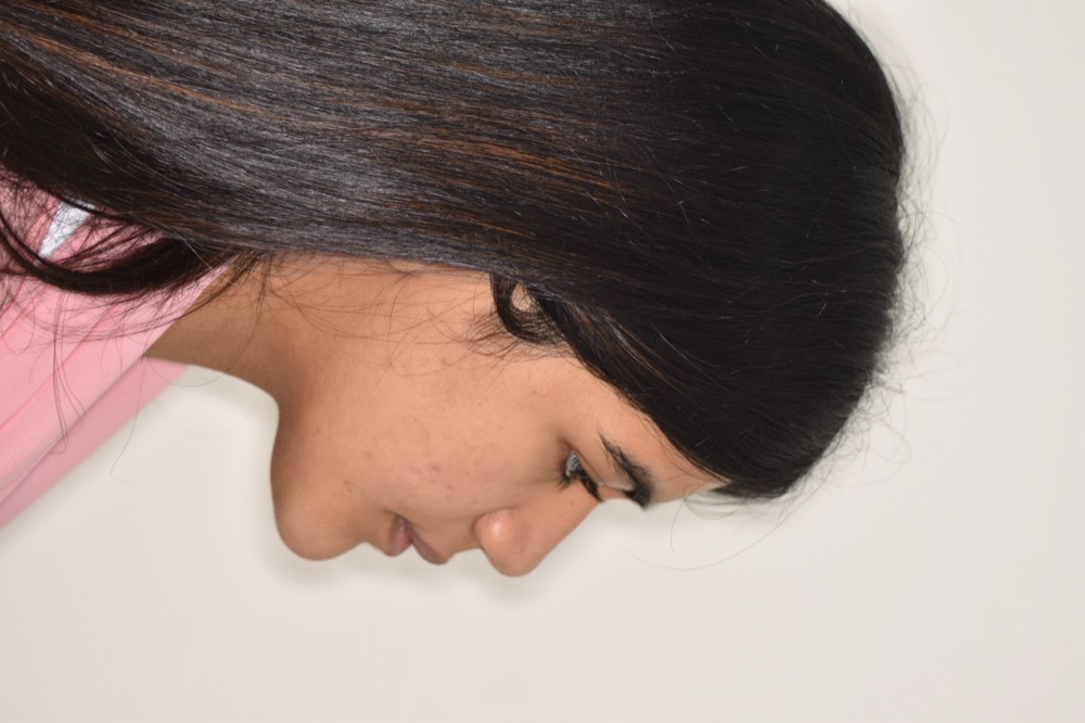 Class III correction with orthognathic surgery after