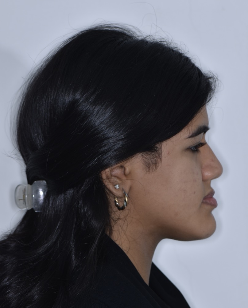 Class III correction with orthognathic surgery before