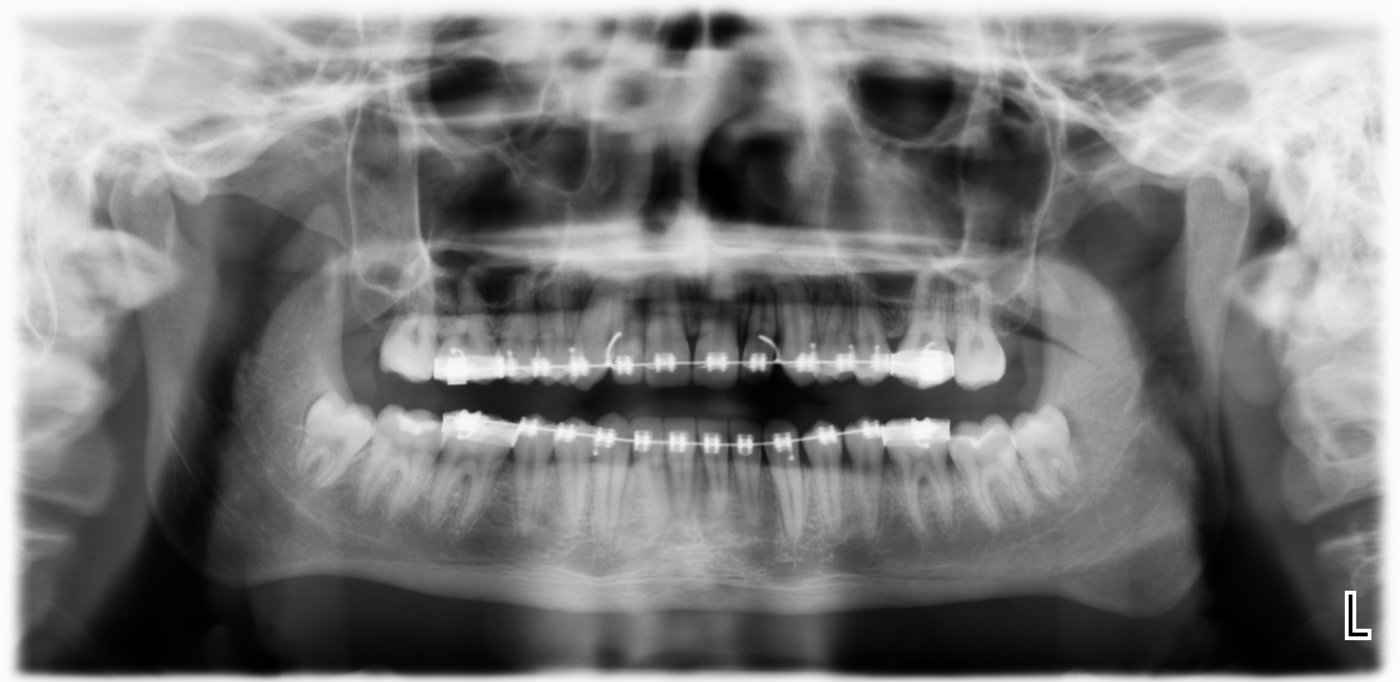 Impacted canine alignment after