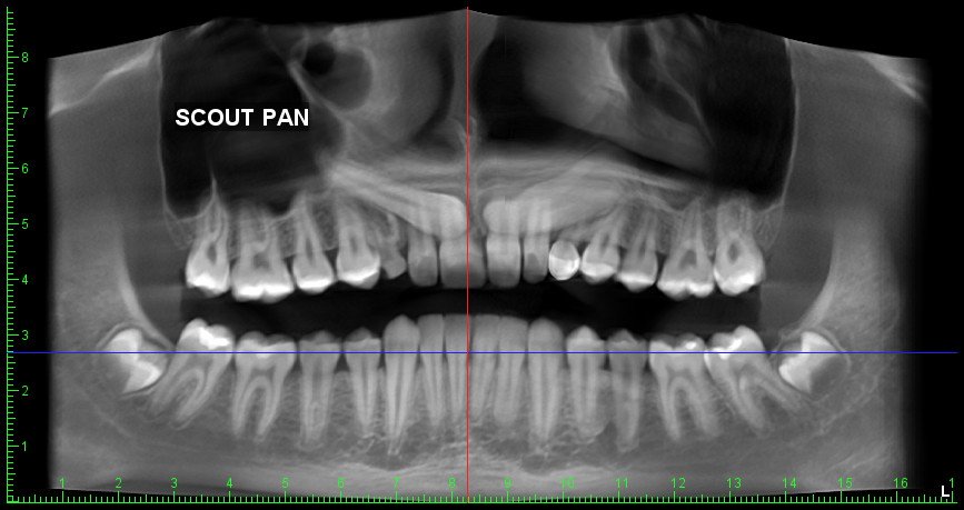 Impacted canine alignment before