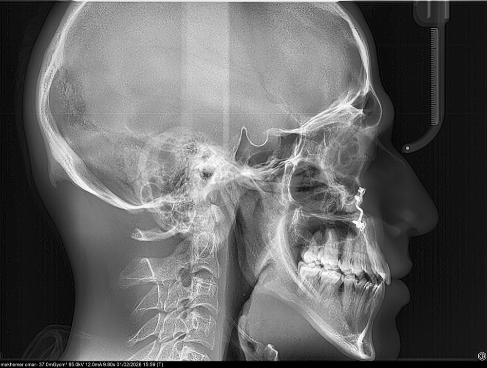 Surgical orthodontic correction after