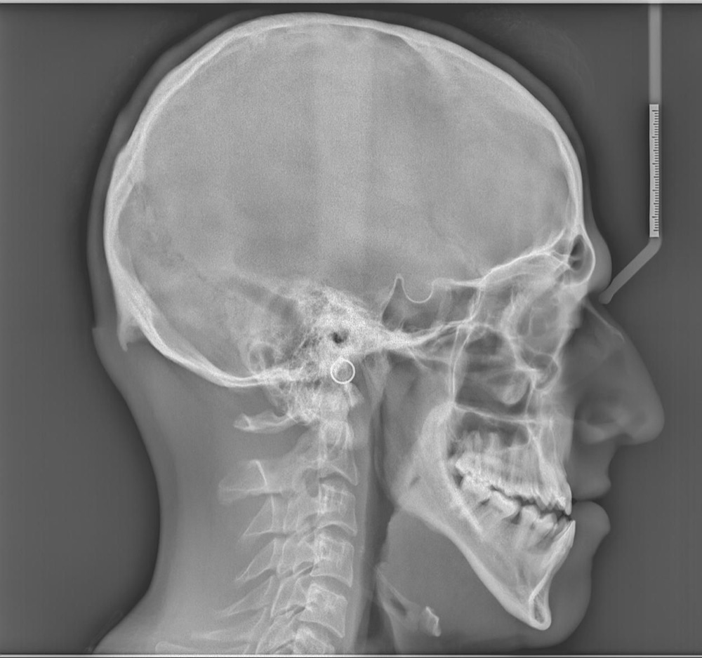 Surgical orthodontic correction before